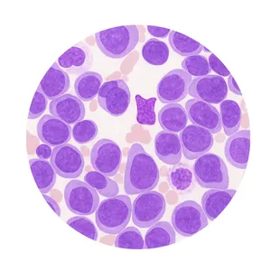 Acute myeloid leukemia