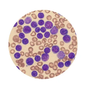 Chronic Lymphocytic Leukemia