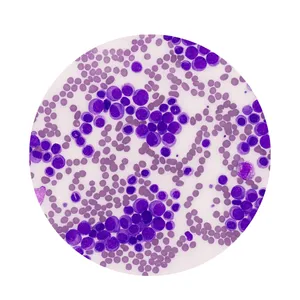 Chronic Myeloid Leukemia